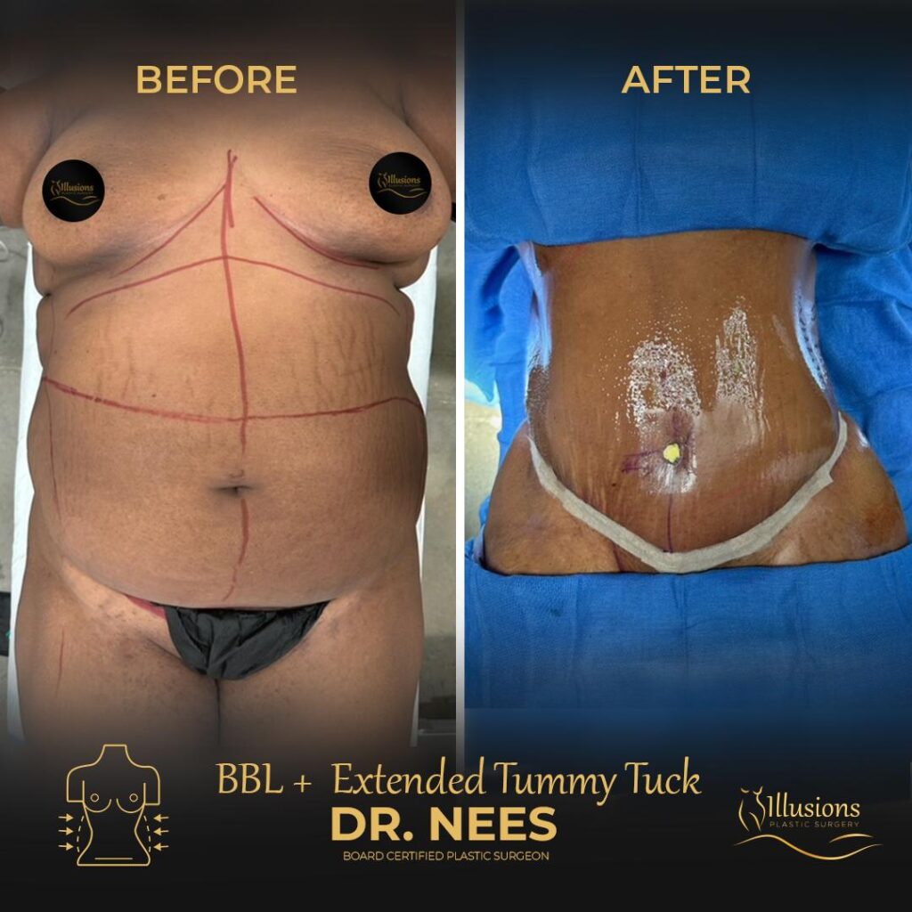 tummy tuck candidate