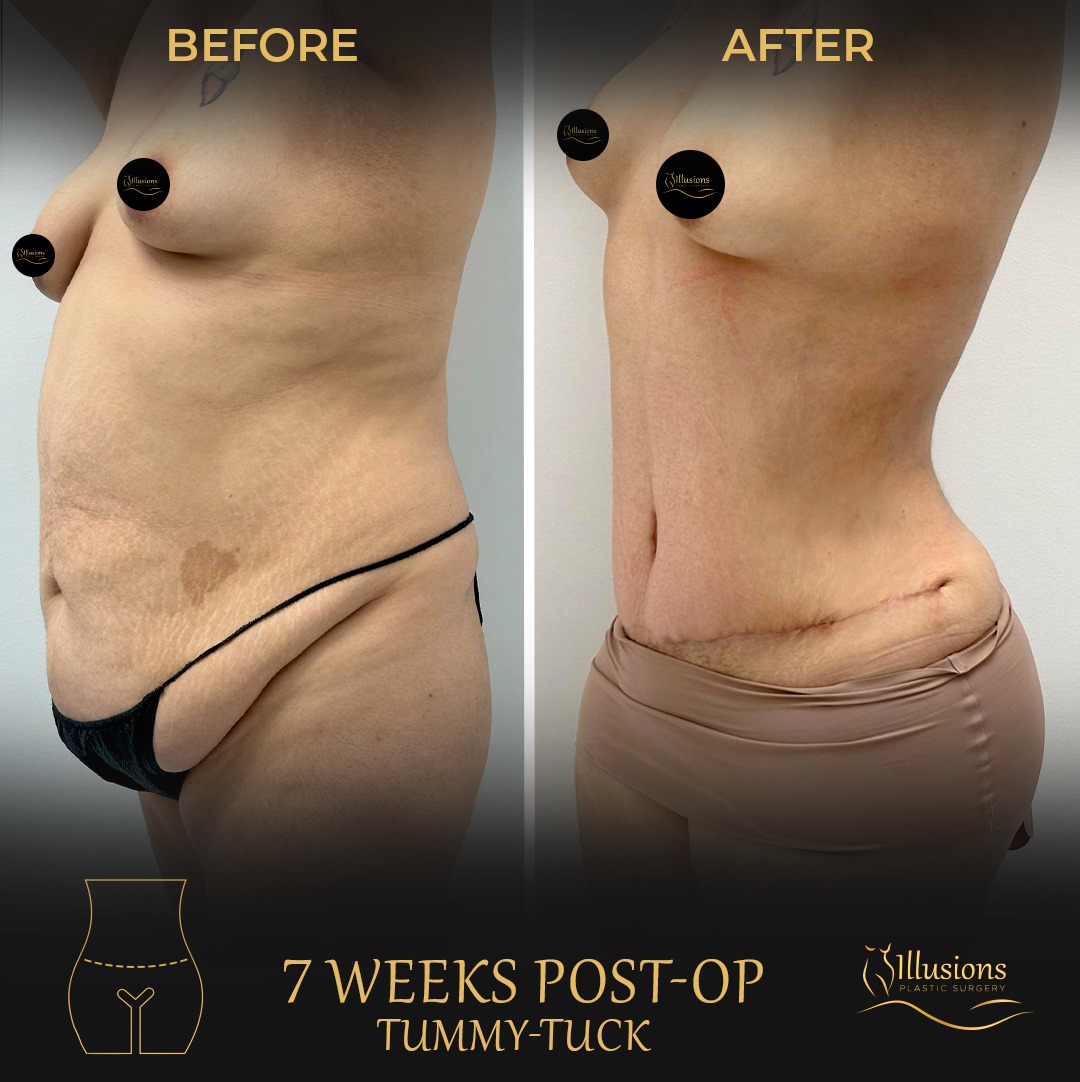 Tummy Tuck