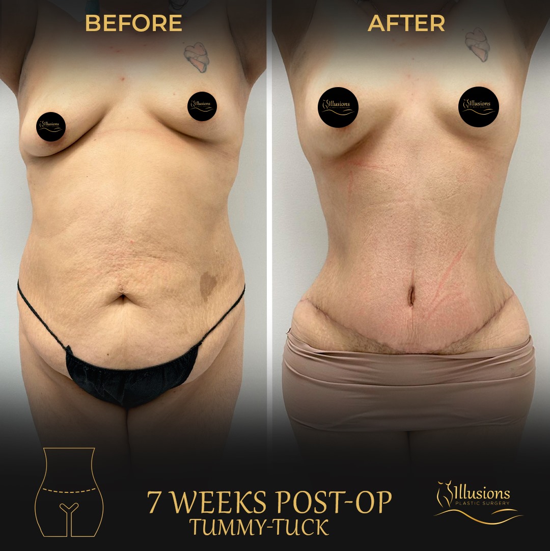 Tummy Tuck