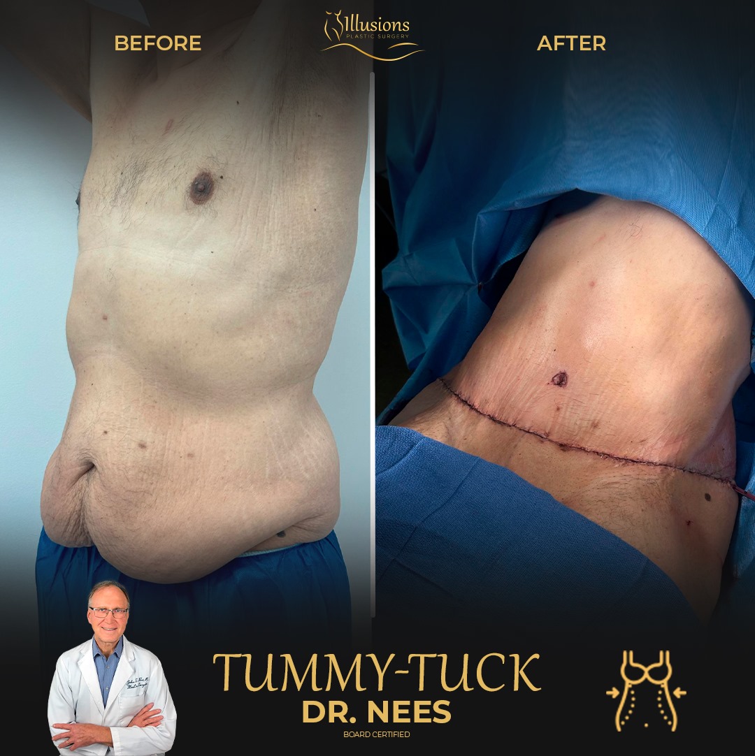 tummy tuck for men by Dr. Ness