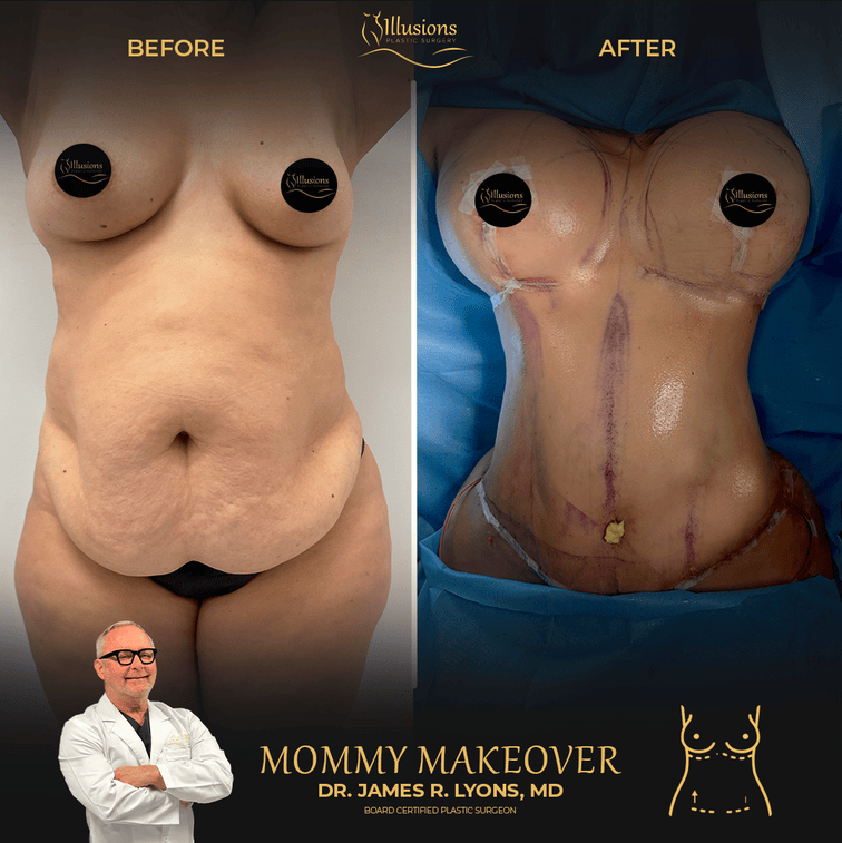 before and after mommy makeover