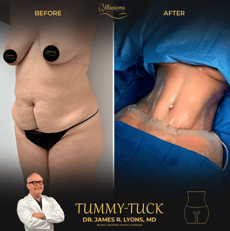 before and after tummy tuck 