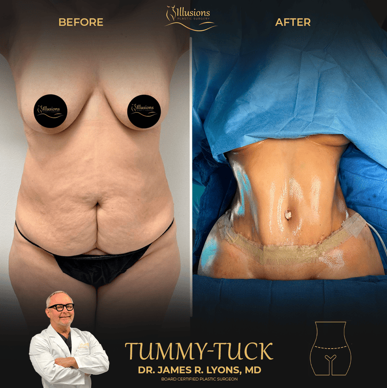tummy tuck Dr Lyons