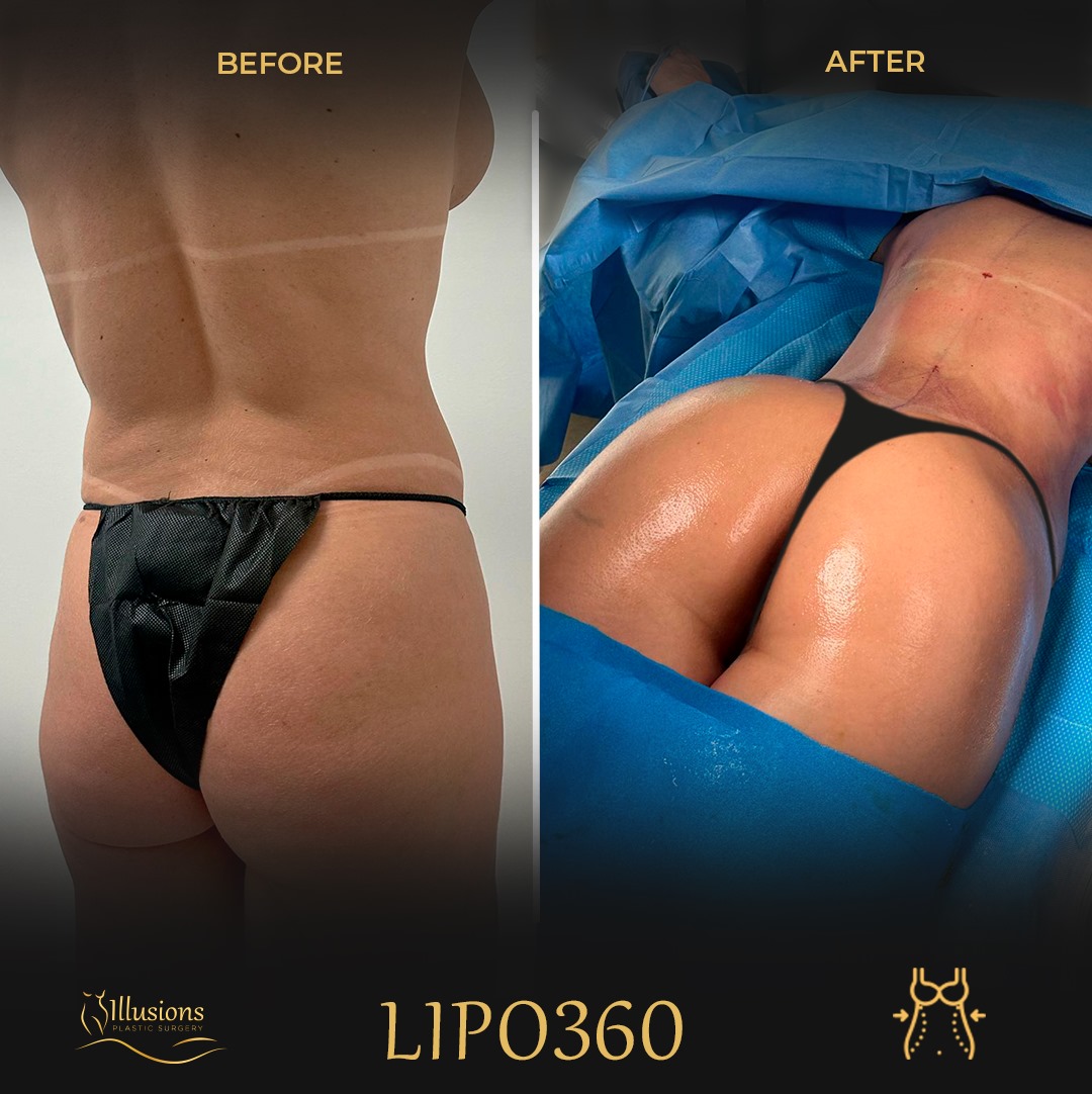 Lipo 360