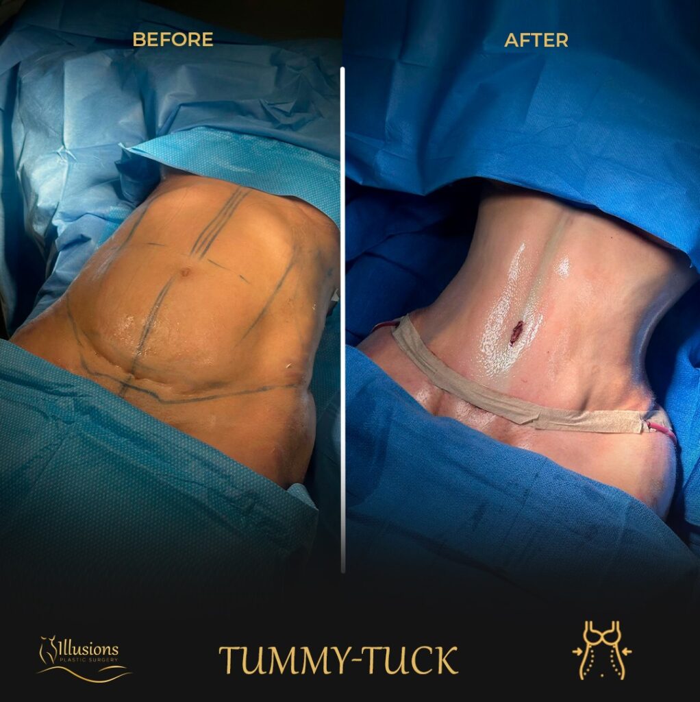 before and after tummy tuck - Dr Lyons