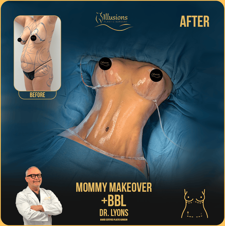 before and after mommy makeover + BBL