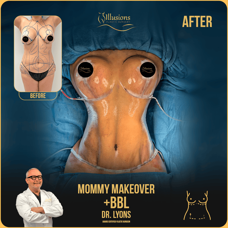 before and after mommy makeover and BBL