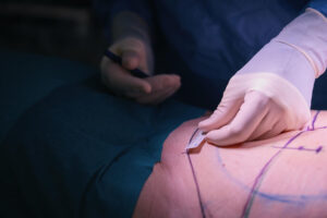 Find the Right Mommy Makeover Surgeon