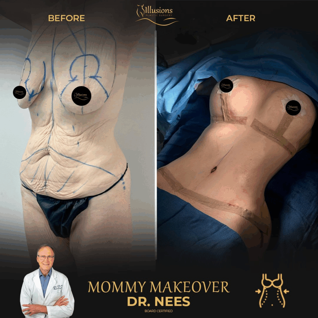 what is included in a mommy makeover