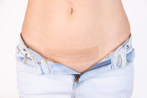 Have Scars After My Mommy Makeover