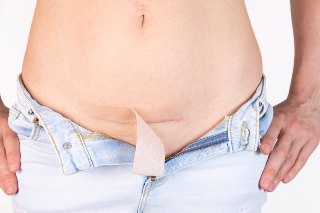 celebrities hide tummy tuck scars