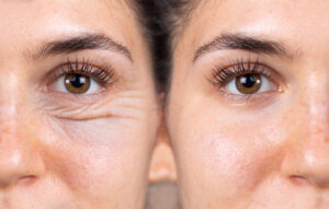 What is blepharoplasty