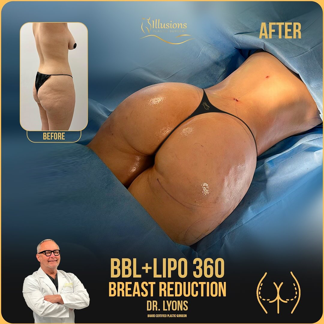Before and after BBL + Lipo 360 + Breast Reduction