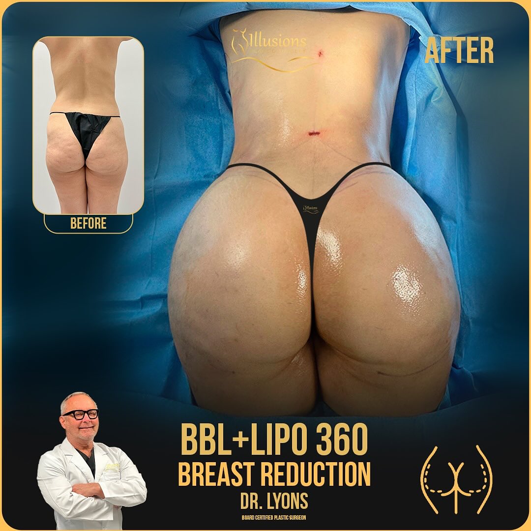 Before and after BBL + Lipo 360 + Breast Reduction