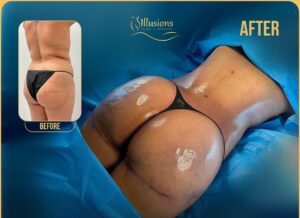 BBL before and after photos