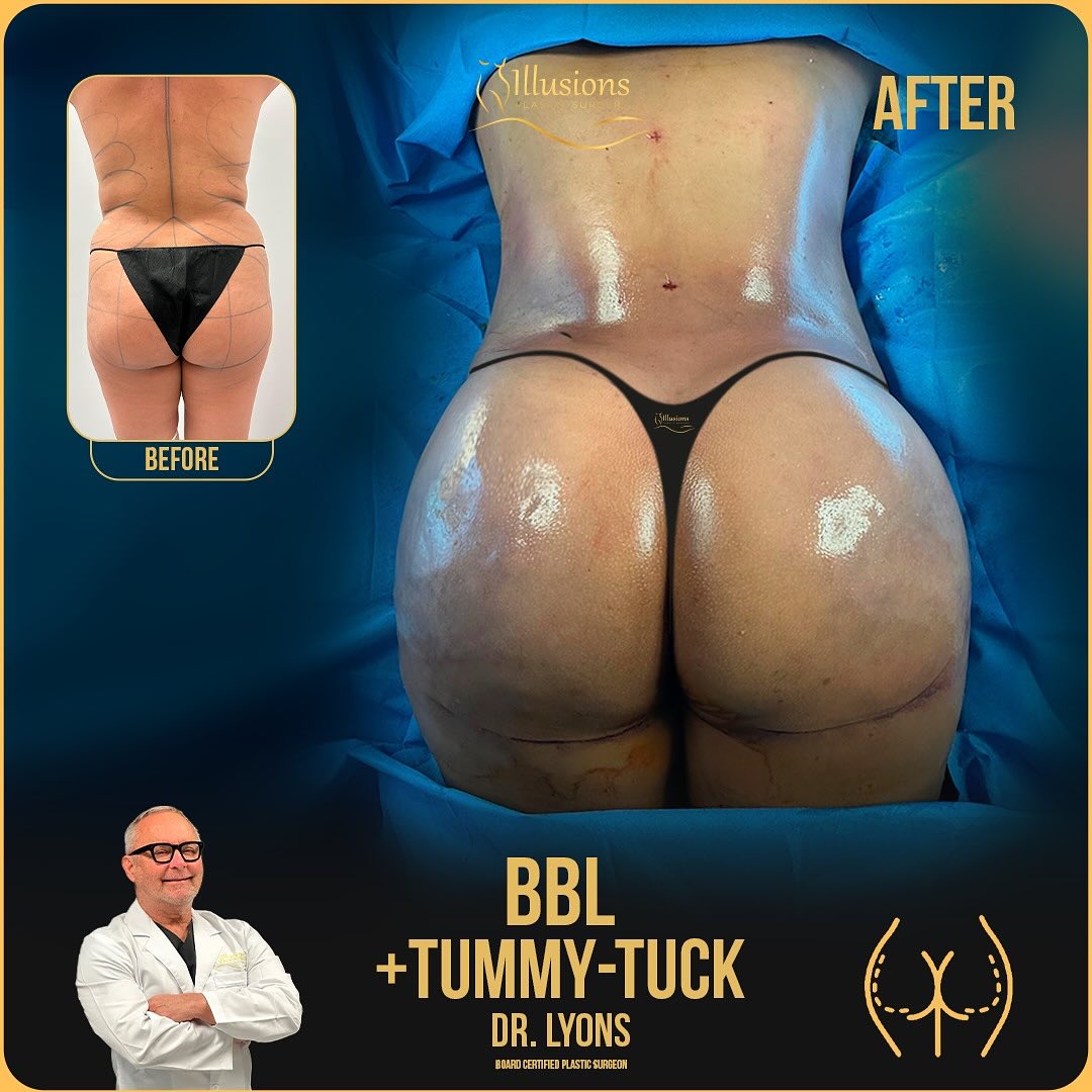 Before and After BBL and Tummy Tuck - Dr Lyons