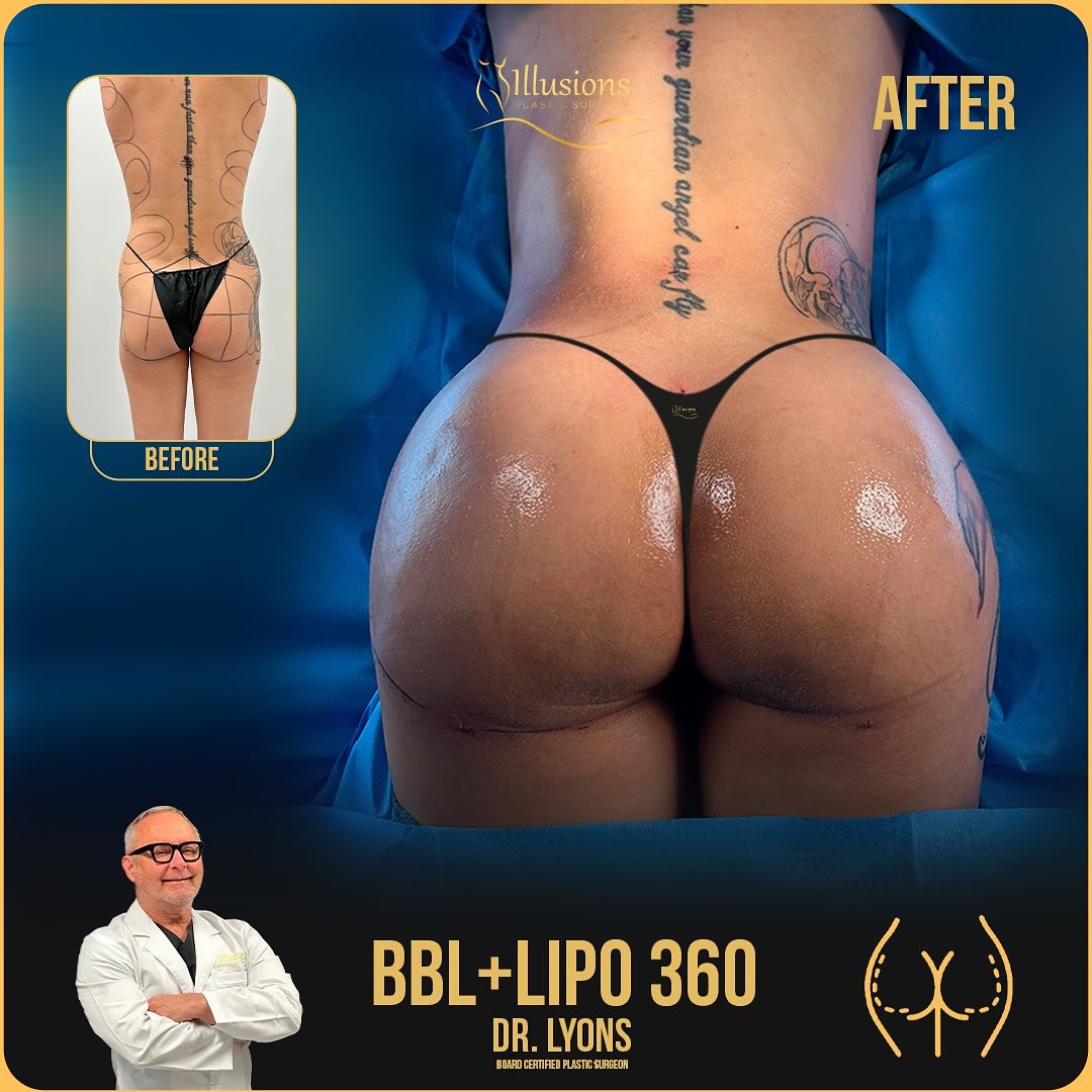 BBL before and after photos + Lipo 360