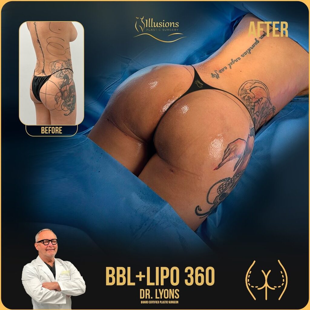BBL before and after photos + Lipo 360