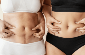 tummy tuck before and after gallery