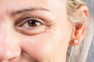 Blepharoplasty vs brow lift