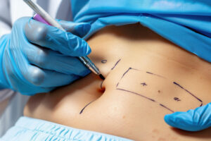 Lipo 360 vs. Tummy Tuck